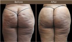 Before And After Gluteal Fat Transfer Treatment